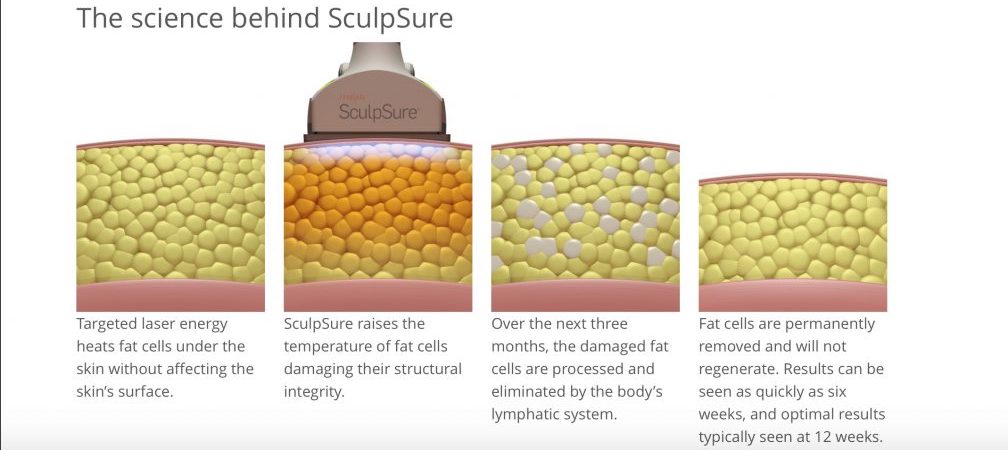 Sculpsure