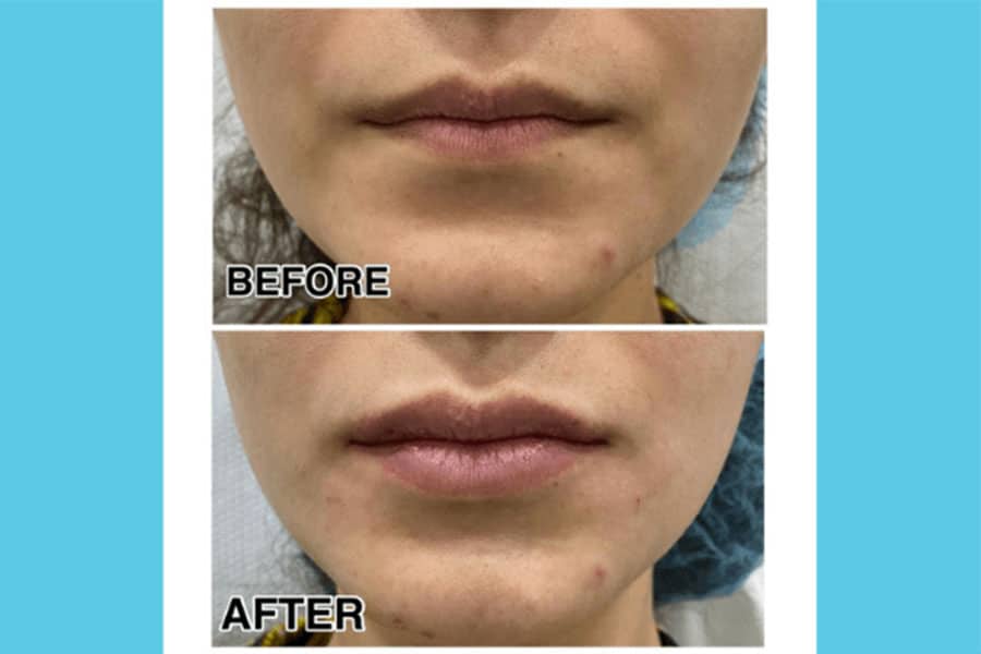 Filler Treatment In Abu Dhabi