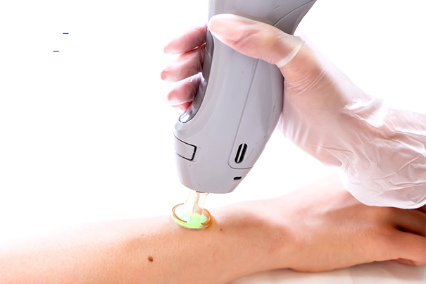 laser treatment